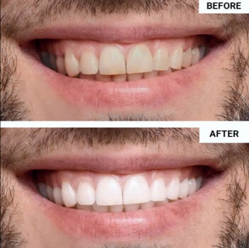 WellaWhite Teeth Whitening Kit customer~Marcus - week 6 – New York, USA